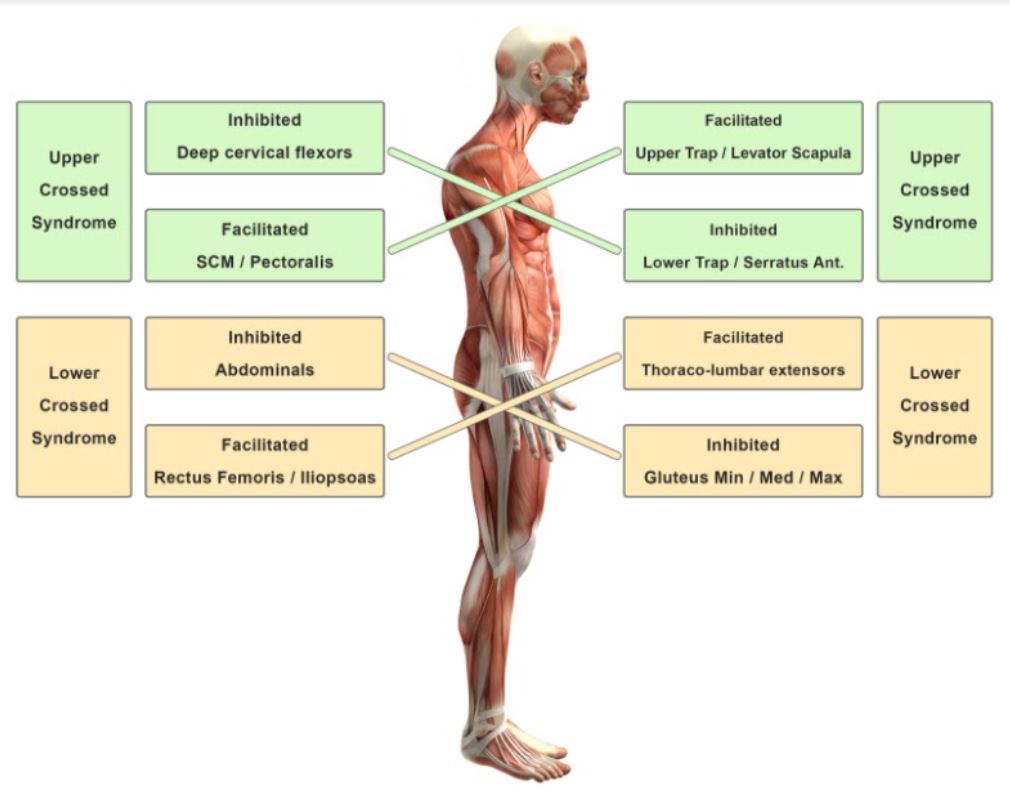 This image describes Upper Cross Syndrome