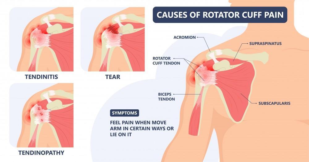 Shoulder pain diagram showing causes of rotator cuff pain