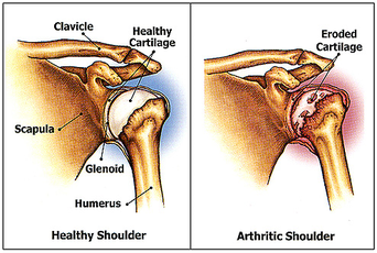 a diagram of Osteoarthritis (OA) in a shoulder
