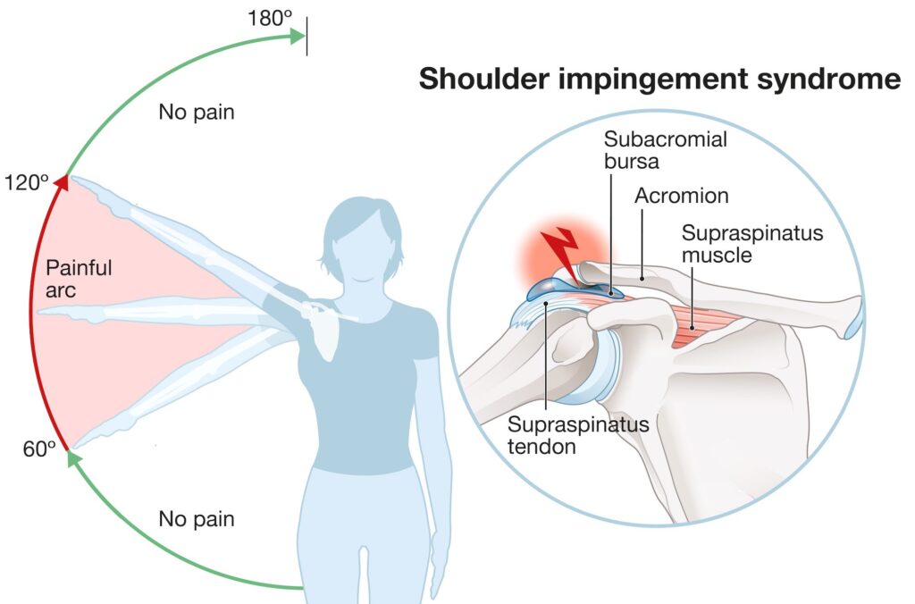 Shoulder impingement with a diagram showing the range of motion