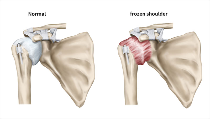 Frozen Shoulder