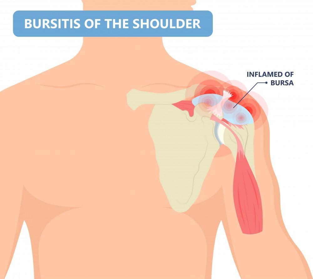 A diagram of shoulder bursitis