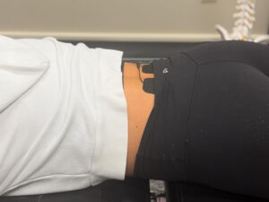Muscle Stimulation Therapy A patient receiving muscle stimulation therapy to heal low back pain