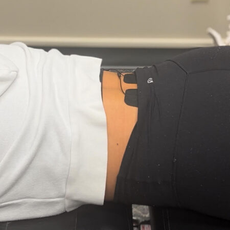 A patient receiving muscle stimulation therapy to heal low back pain